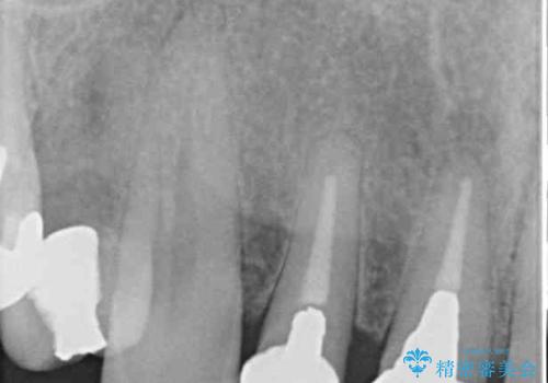 痛む前歯　破折してしまった歯のインプラント補綴治療の治療前