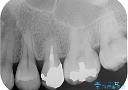 オールセラミッククラウンによる奥歯のむし歯治療の治療前