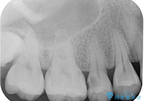 オールセラミッククラウンによる奥歯のむし歯治療の治療前