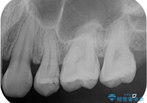 奥歯に物が挟まる　セラミックインレーでのむし歯治療の治療前