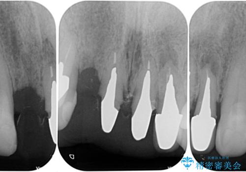 仮歯が汚くて転院 前歯のオールセラミッククラウン治療の治療前