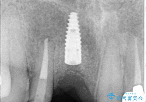痛む前歯　破折してしまった歯のインプラント補綴治療の治療中