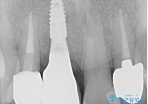 痛む前歯　破折してしまった歯のインプラント補綴治療の治療後