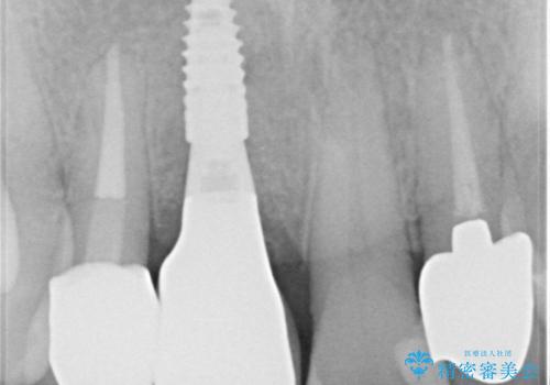 痛む前歯 破折してしまった歯のインプラント補綴治療の治療後