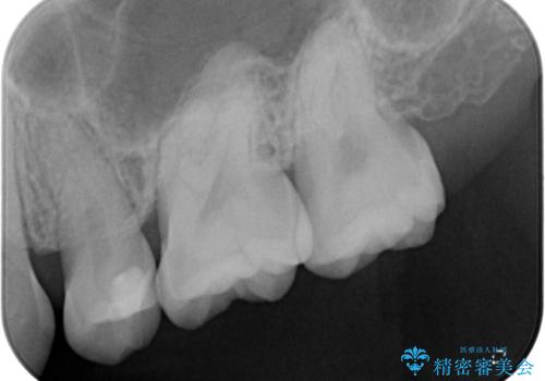 奥歯に物が挟まる　セラミックインレーでのむし歯治療の治療後