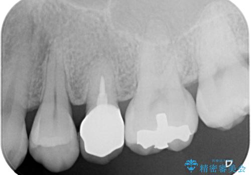 オールセラミッククラウンによる奥歯のむし歯治療の治療後
