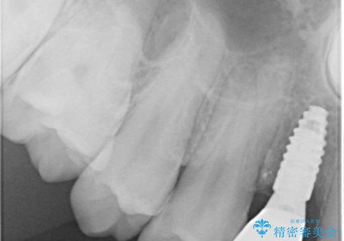 歯が生えてこない　インプラントによる補綴治療の治療後