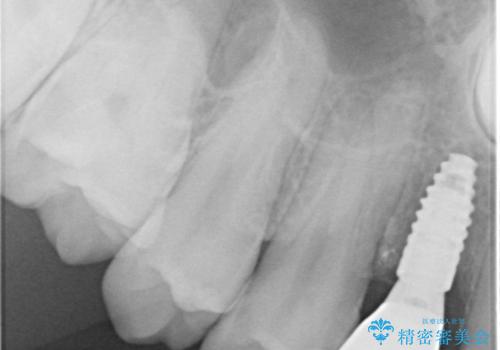 歯が生えてこない インプラントによる補綴治療の治療後