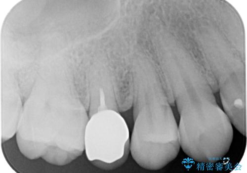 オールセラミッククラウンによる奥歯のむし歯治療の治療後