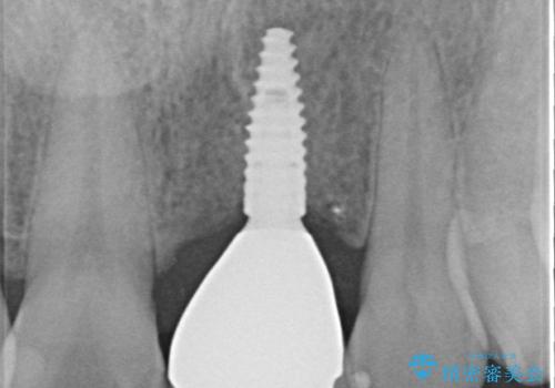 歯茎に溝が　大きく欠損した前歯のインプラント補綴治療の治療後