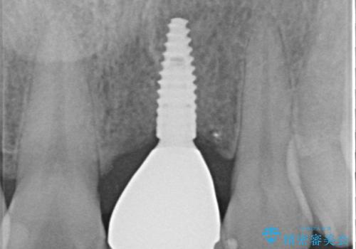 歯茎に溝が 大きく欠損した前歯のインプラント補綴治療の治療後