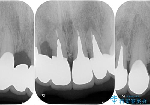 仮歯が汚くて転院　前歯のオールセラミッククラウン治療の治療後