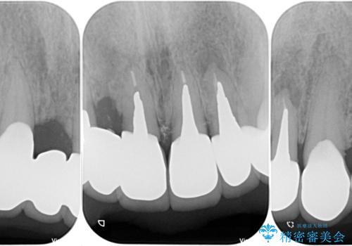 仮歯が汚くて転院 前歯のオールセラミッククラウン治療の治療後