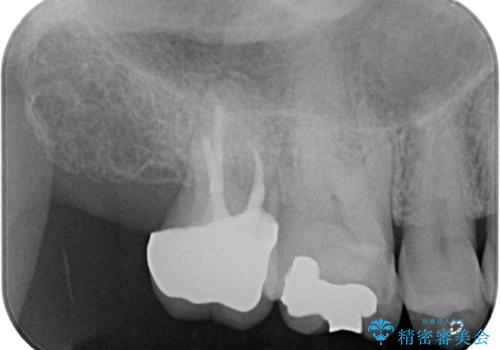 外側に飛び出している歯 部分矯正を用いた奥歯の補綴治療の治療後