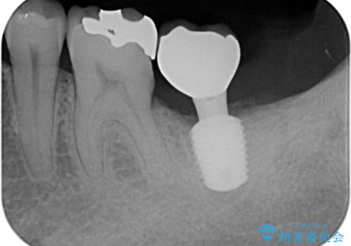 外側に飛び出している歯 部分矯正を用いた奥歯の補綴治療の治療後