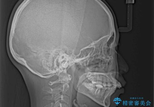 唇を閉じてもはみ出してしまう上顎前歯　抜歯矯正で口元を改善の治療前