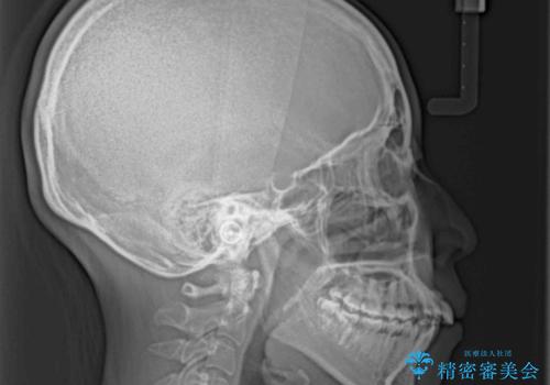 気になる上顎前突 補助装置を用いた抜歯矯正で口元をすっきりとの治療前