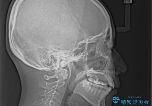 前歯のデコボコを抜歯矯正でスッキリした口元にの治療前