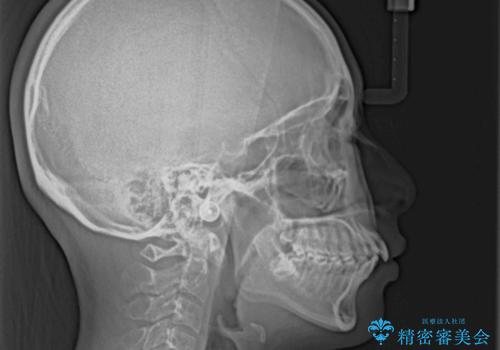 口元が出ているのを改善したい。 クリアブラケットによる抜歯矯正の治療前