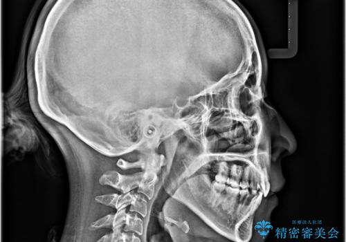 気になる上顎前突 補助装置を用いた抜歯矯正で口元をすっきりとの治療後
