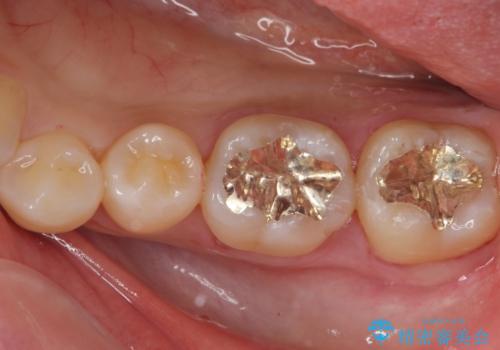 【歯に穴が空いている】ゴールドインレーで修復の症例 治療後