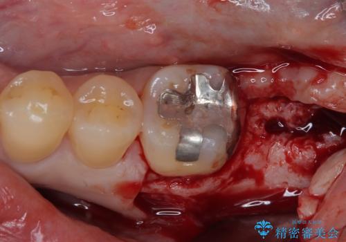 外側に飛び出している歯 部分矯正を用いた奥歯の補綴治療の治療中