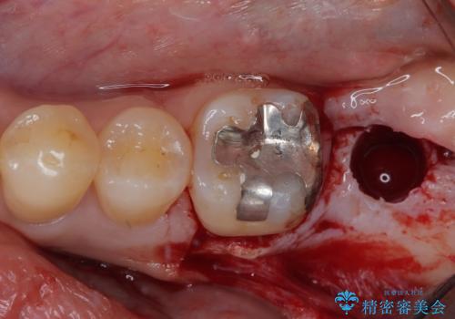 外側に飛び出している歯 部分矯正を用いた奥歯の補綴治療の治療後