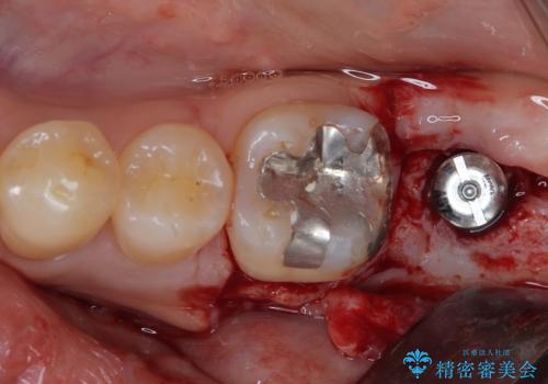 外側に飛び出している歯 部分矯正を用いた奥歯の補綴治療の治療前