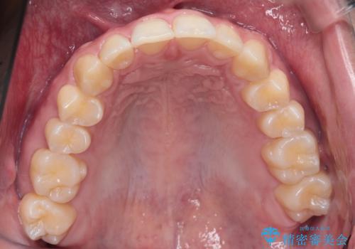 【インビザライン】短期間で出っ歯を治したいの治療後