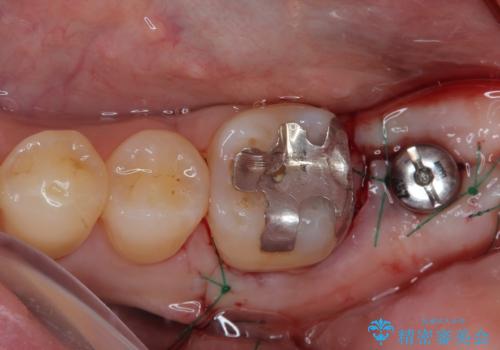 外側に飛び出している歯 部分矯正を用いた奥歯の補綴治療の治療中