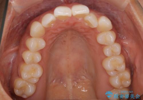 【インビザライン】前歯をきれいな歯並びにしたいの治療前