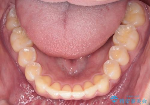 【インビザライン】短期間で出っ歯を治したいの治療後