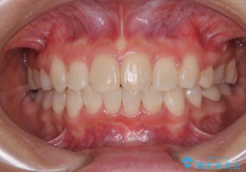 唇を閉じてもはみ出してしまう上顎前歯 抜歯矯正で口元を改善の症例 治療後