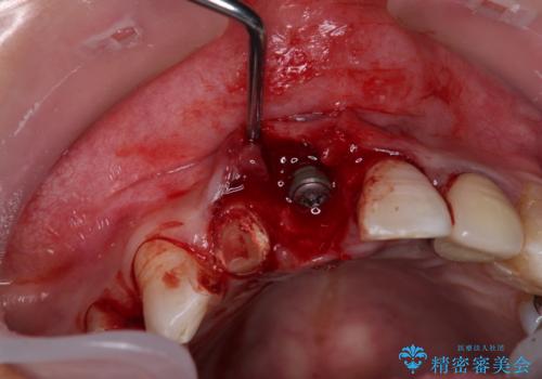 痛む前歯 破折してしまった歯のインプラント補綴治療の治療前