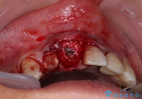 痛む前歯　破折してしまった歯のインプラント補綴治療の治療中