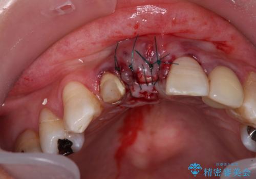 痛む前歯　破折してしまった歯のインプラント補綴治療の治療後