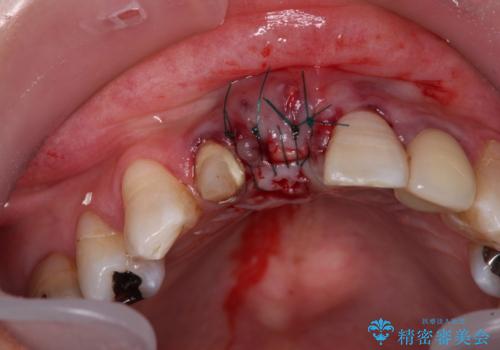 痛む前歯 破折してしまった歯のインプラント補綴治療の治療後