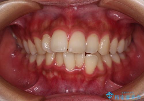 気になる上顎前突 補助装置を用いた抜歯矯正で口元をすっきりとの症例 治療前