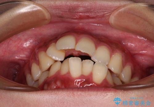 気になる上顎前突 補助装置を用いた抜歯矯正で口元をすっきりとの治療前