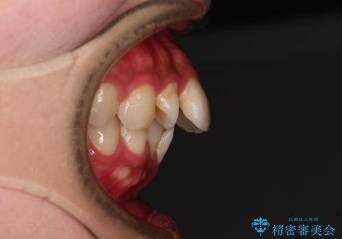 気になる上顎前突 補助装置を用いた抜歯矯正で口元をすっきりとの治療前