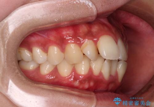 気になる上顎前突 補助装置を用いた抜歯矯正で口元をすっきりとの治療前