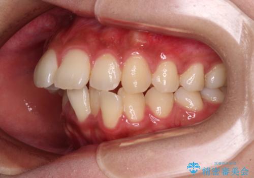 気になる上顎前突 補助装置を用いた抜歯矯正で口元をすっきりとの治療前