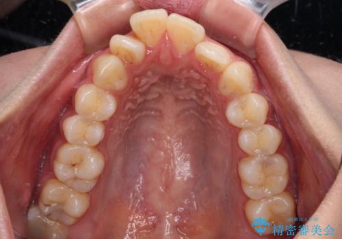 気になる上顎前突 補助装置を用いた抜歯矯正で口元をすっきりとの治療前