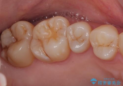 オールセラミッククラウンによる奥歯のむし歯治療の症例 治療前
