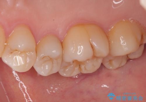 オールセラミッククラウンによる奥歯のむし歯治療の治療前