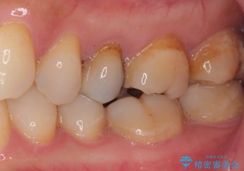 オールセラミッククラウンによる奥歯のむし歯治療の治療前
