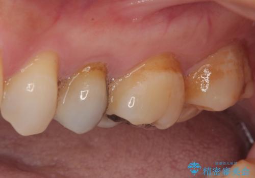 オールセラミッククラウンによる奥歯のむし歯治療の治療前