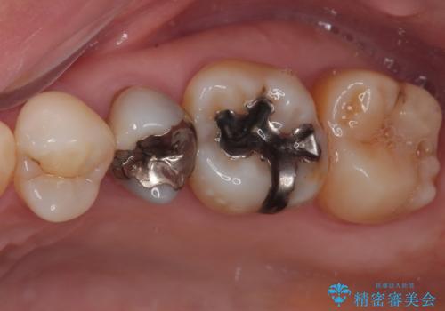 オールセラミッククラウンによる奥歯のむし歯治療の治療前