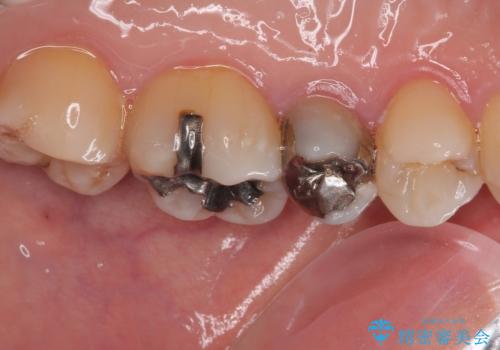 オールセラミッククラウンによる奥歯のむし歯治療の治療前