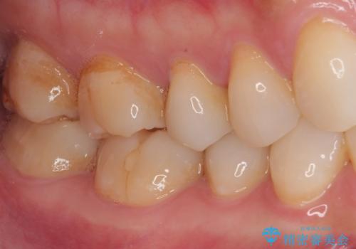 オールセラミッククラウンによる奥歯のむし歯治療の治療前